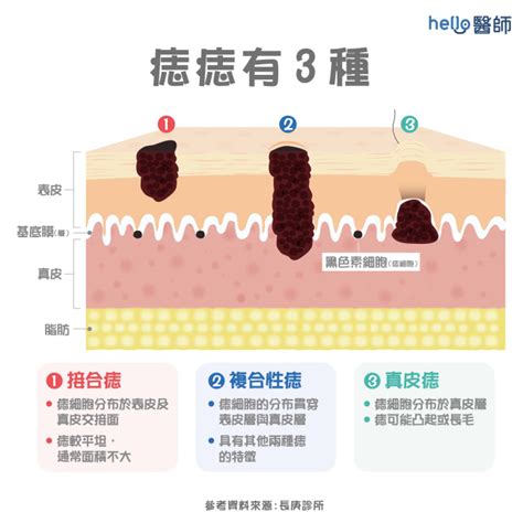 右下巴痣長毛|痣形成的原因？痣長毛、痣變多變大是痣病變？5招判。